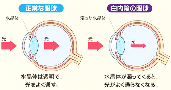 病名から病気を知る 医療法人きしもと眼科 羽曳野市の眼科