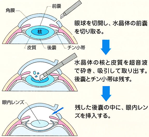 超音波水晶体乳化吸引術