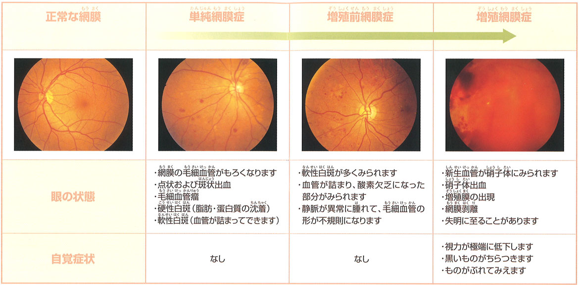 糖尿病網膜症の進行段階