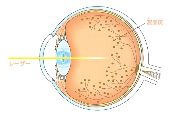 レーザー光凝固術