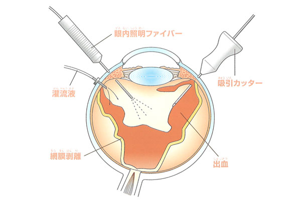 硝子体手術