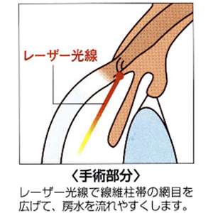 選択的レーザー線維柱帯形成術