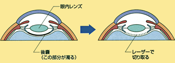 YAGレーザー