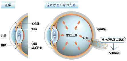 1.緑内障とは？