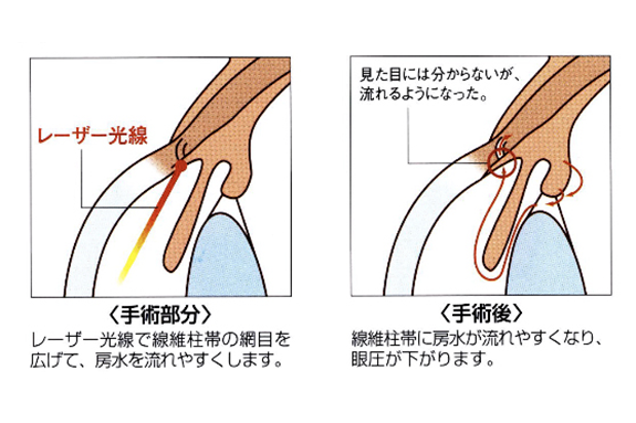 3.SLTの効果