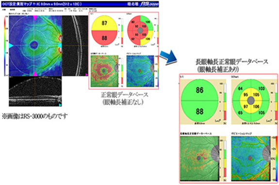 OCTの長眼軸長正常眼データベースソフトを導入いたしました！