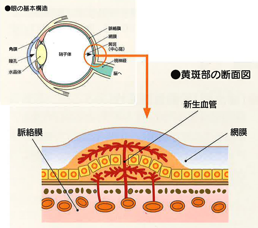 加齢黄斑変性