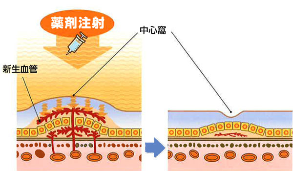 抗血管新生療法