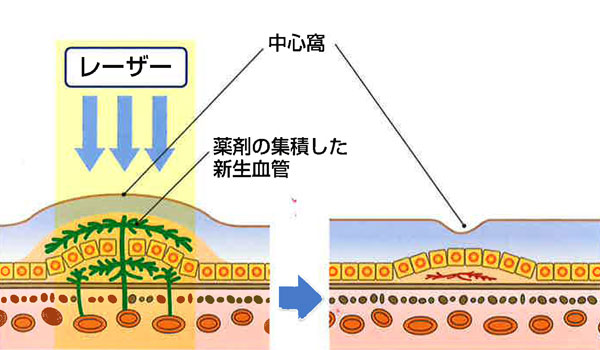 光線力学的療法