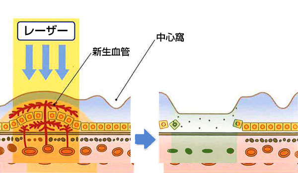 レーザー光凝固術