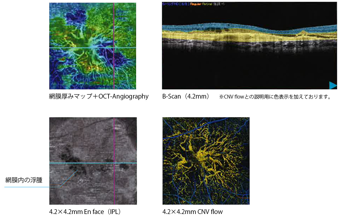 OCT-Angiographyで網膜毛細血管を観察