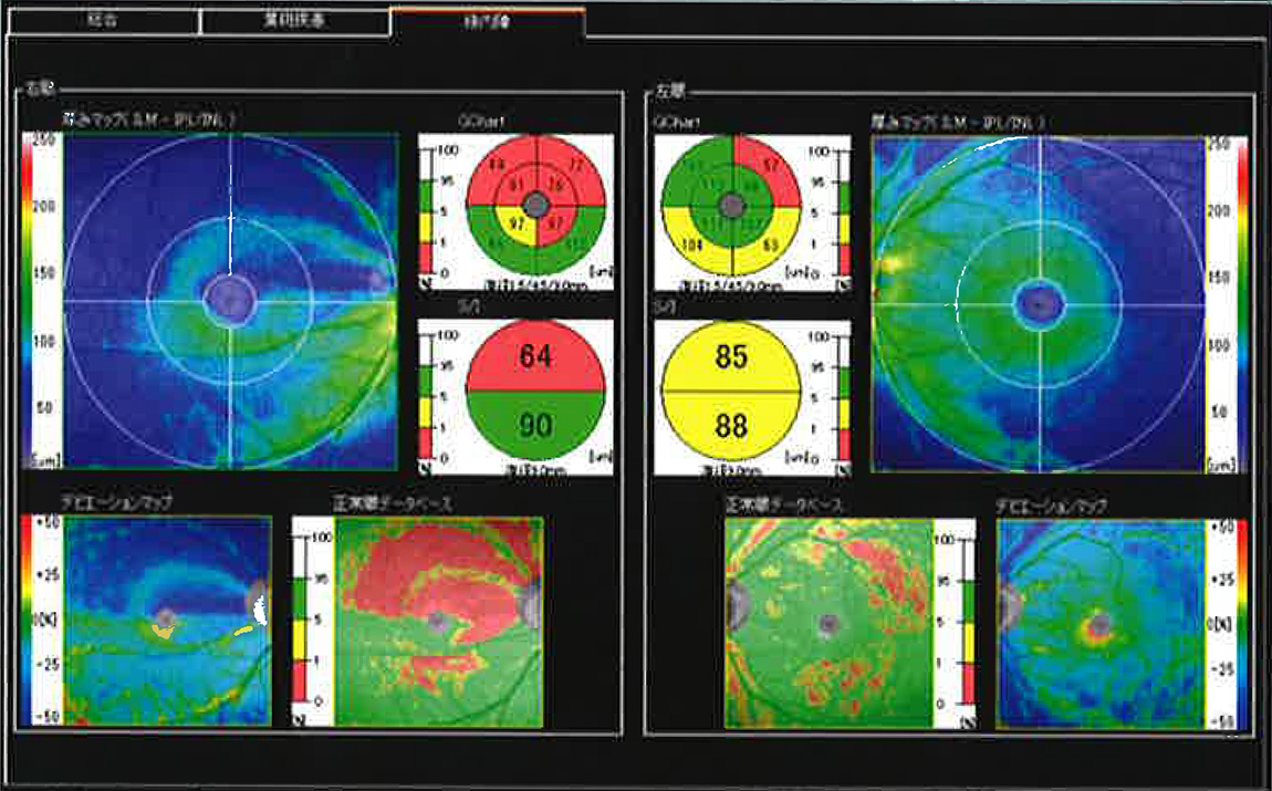 黄斑マップ:緑内障 [NFL+GCL+IPL]CL+IPL]