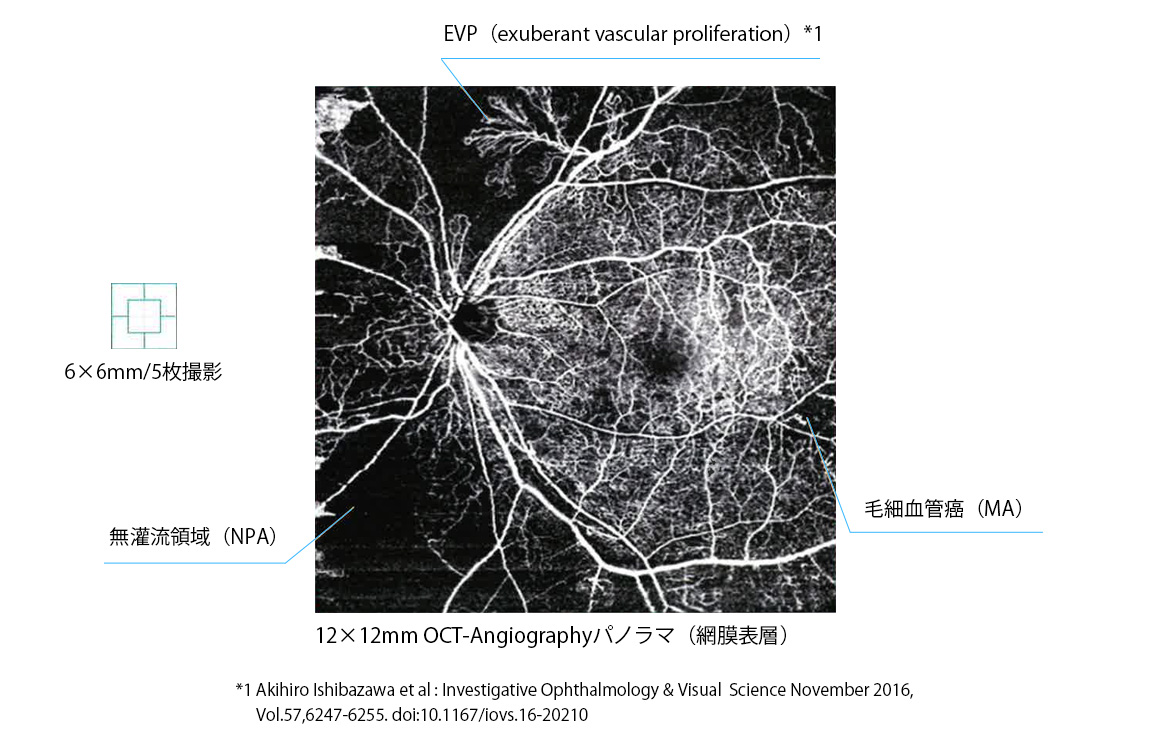 OCT-Angiographyの可能性を広げる新パノラマ機能