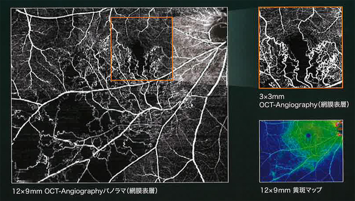 OCT-Angiographyによる無灌流領域の観察