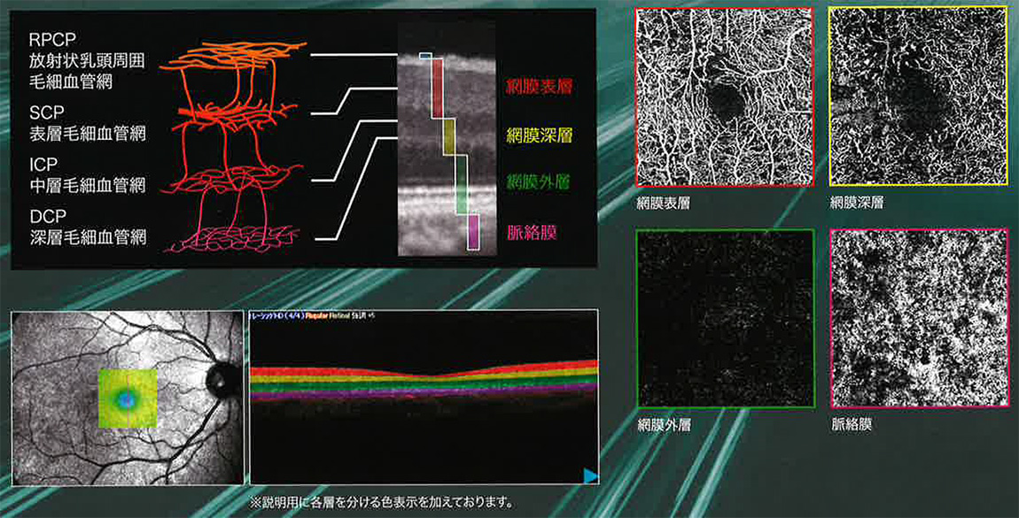 OCT-Angiographyで網膜毛細血管を観察