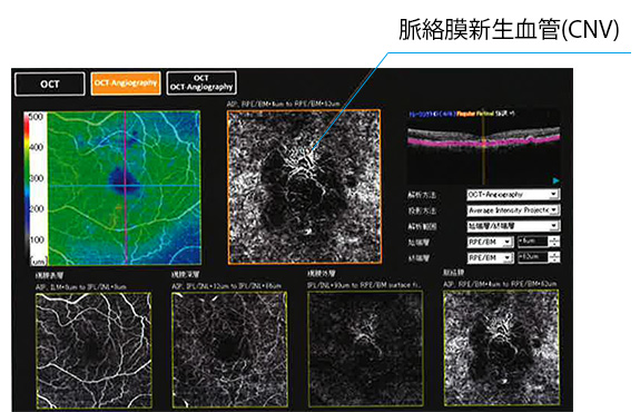 OCT-Angiographyで網膜毛細血管を観察