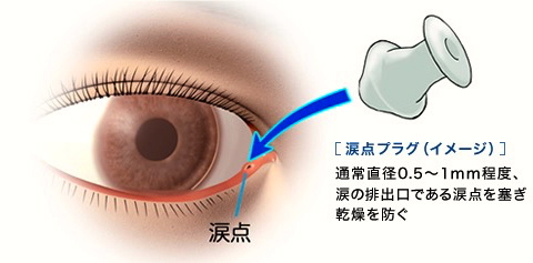 涙点プラグ